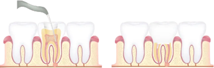 歯の内部補修