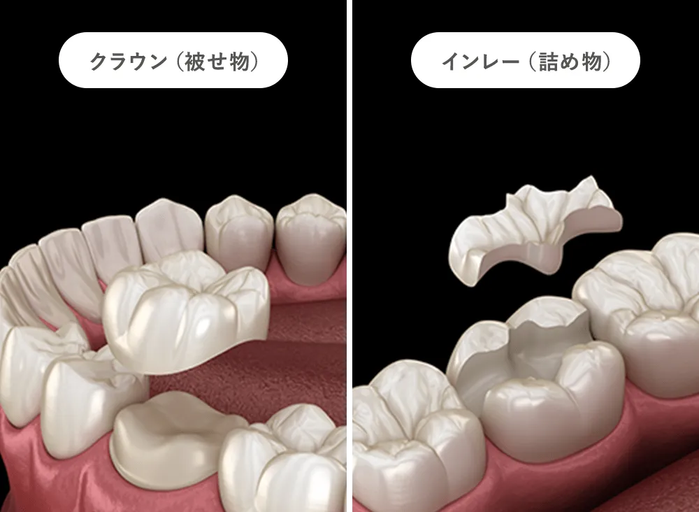 審美設計は歯の形と素材選びで決まります ほてつ治療