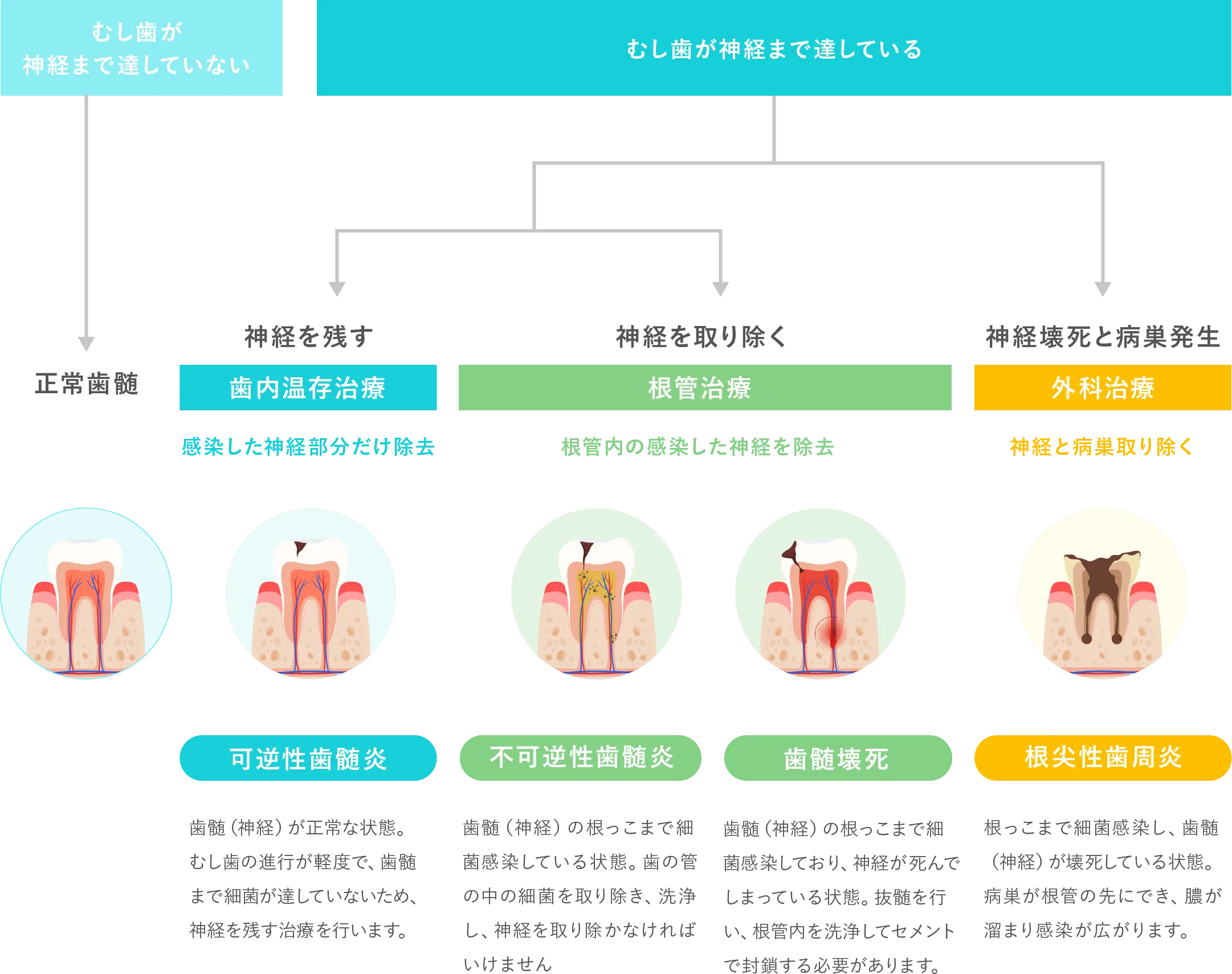 歯内療法フローチャート