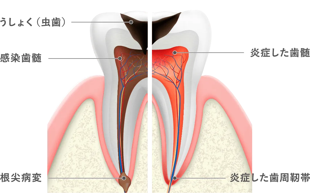 根管治療が必要となる歯髄炎と症状