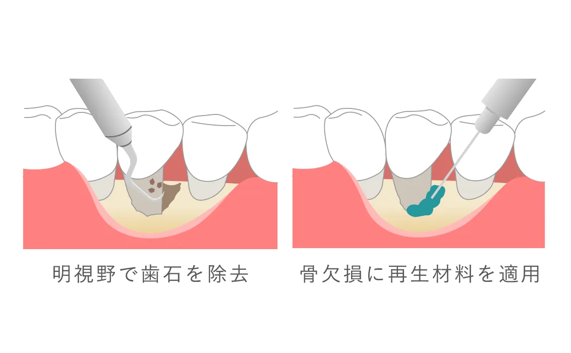 歯周外科 歯周組織再生療法