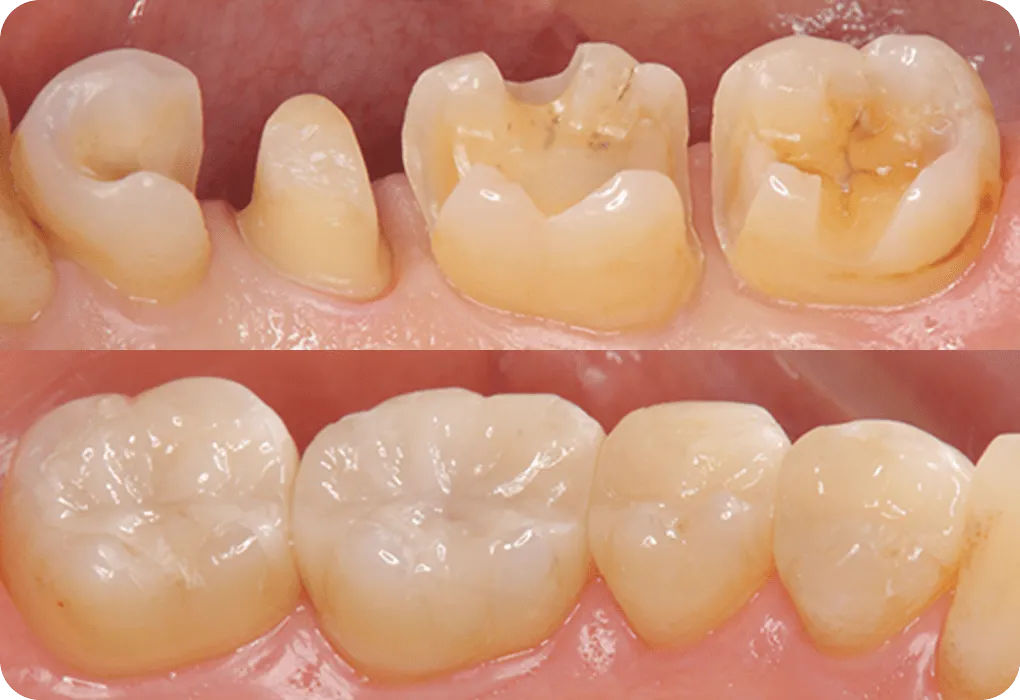 歯を修復し、温存するCR 修復治療