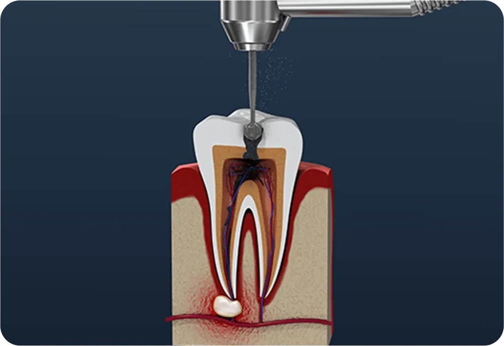 歯の内部から治療する根管治療 歯内療法