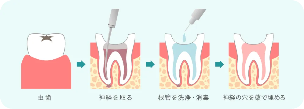 歯の内部から治療する根管治療 歯内療法