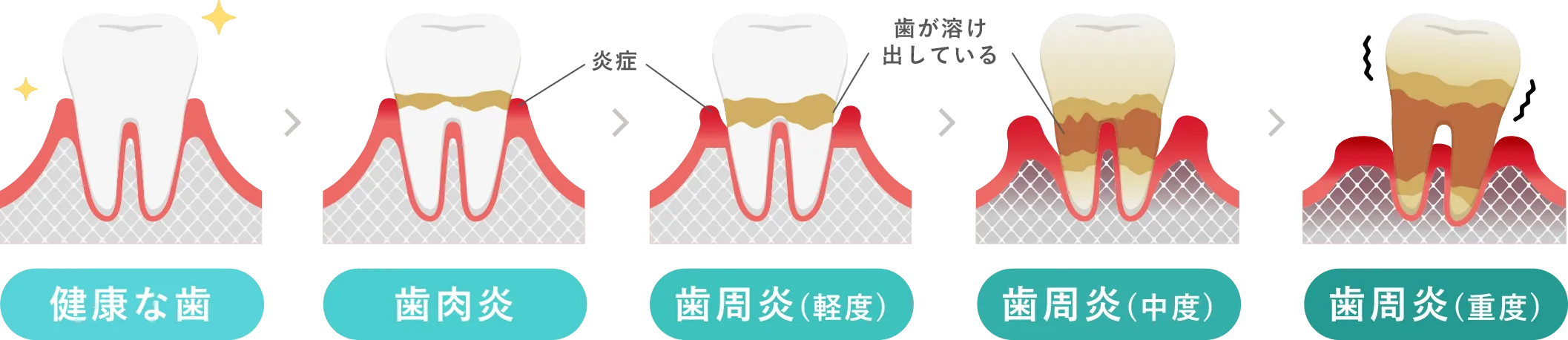 歯周病の進行ステージ