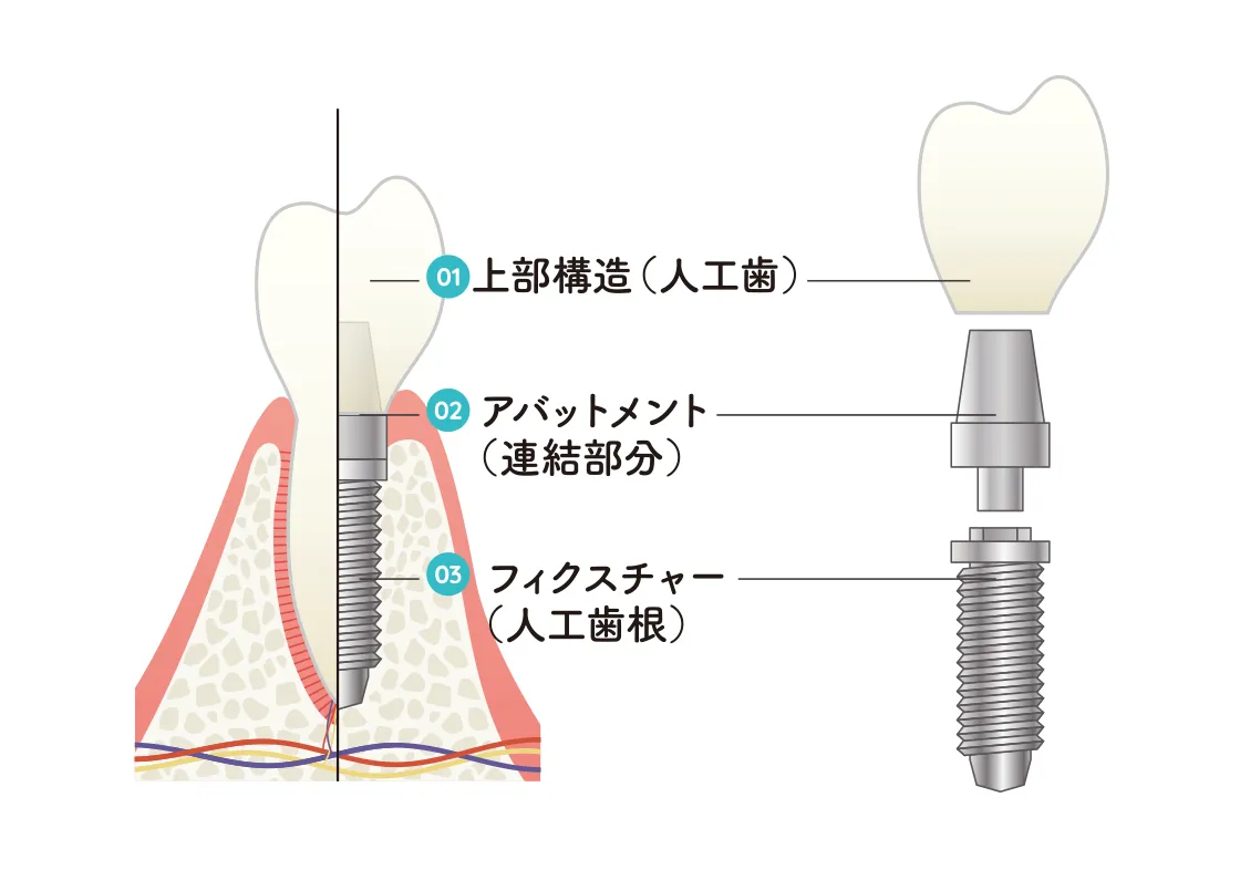 支柱・土台・人工歯で支えるインプラント インプラント構造