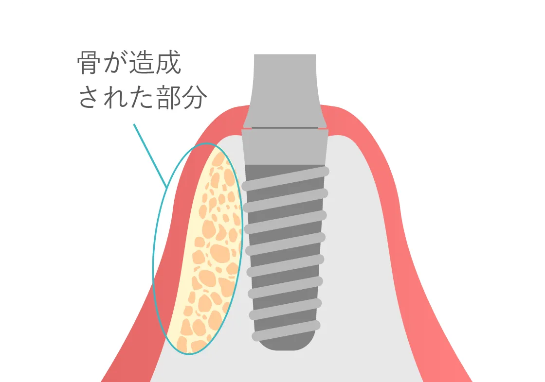 支柱・土台・人工歯で支えるインプラント インプラント構造